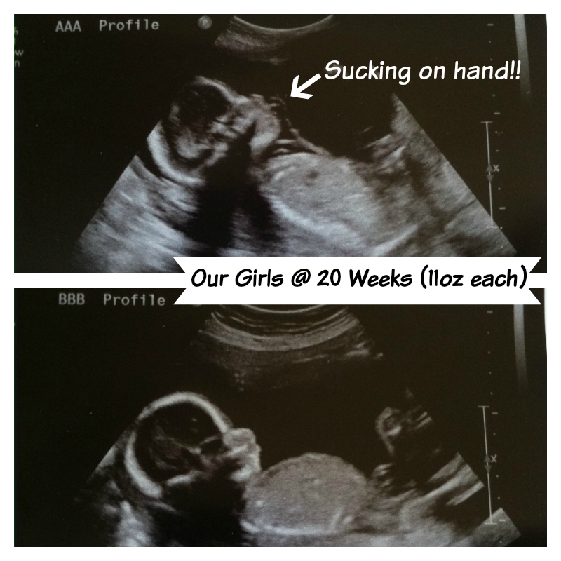 8 week ultrasound hidden twins